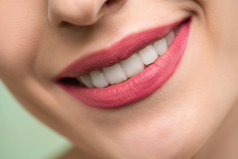 Faccette Dentali